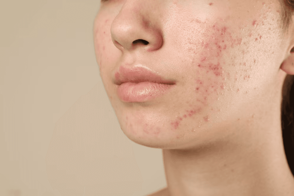 acne condition image