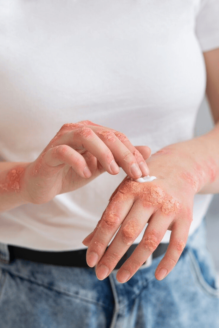 eczema / psoriasis with corticosteroids condition image