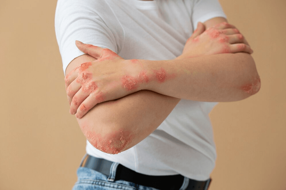 eczema / psoriasis condition image