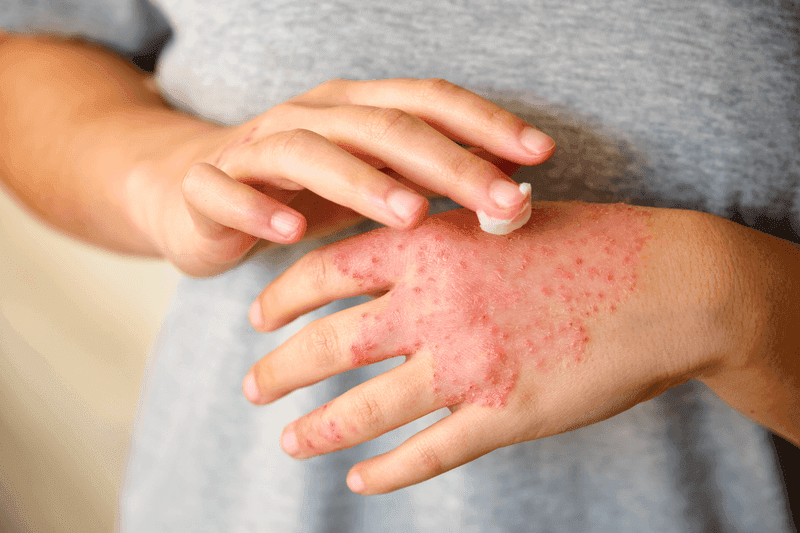 dermatitis condition image