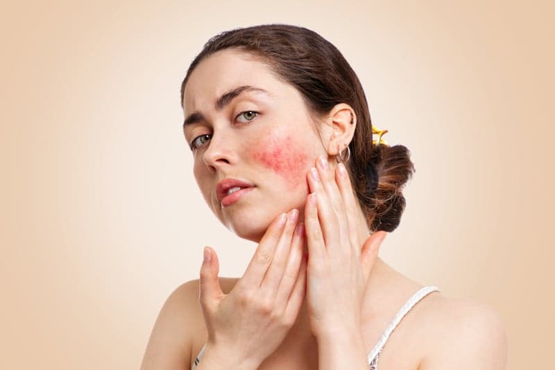 rosacea condition image